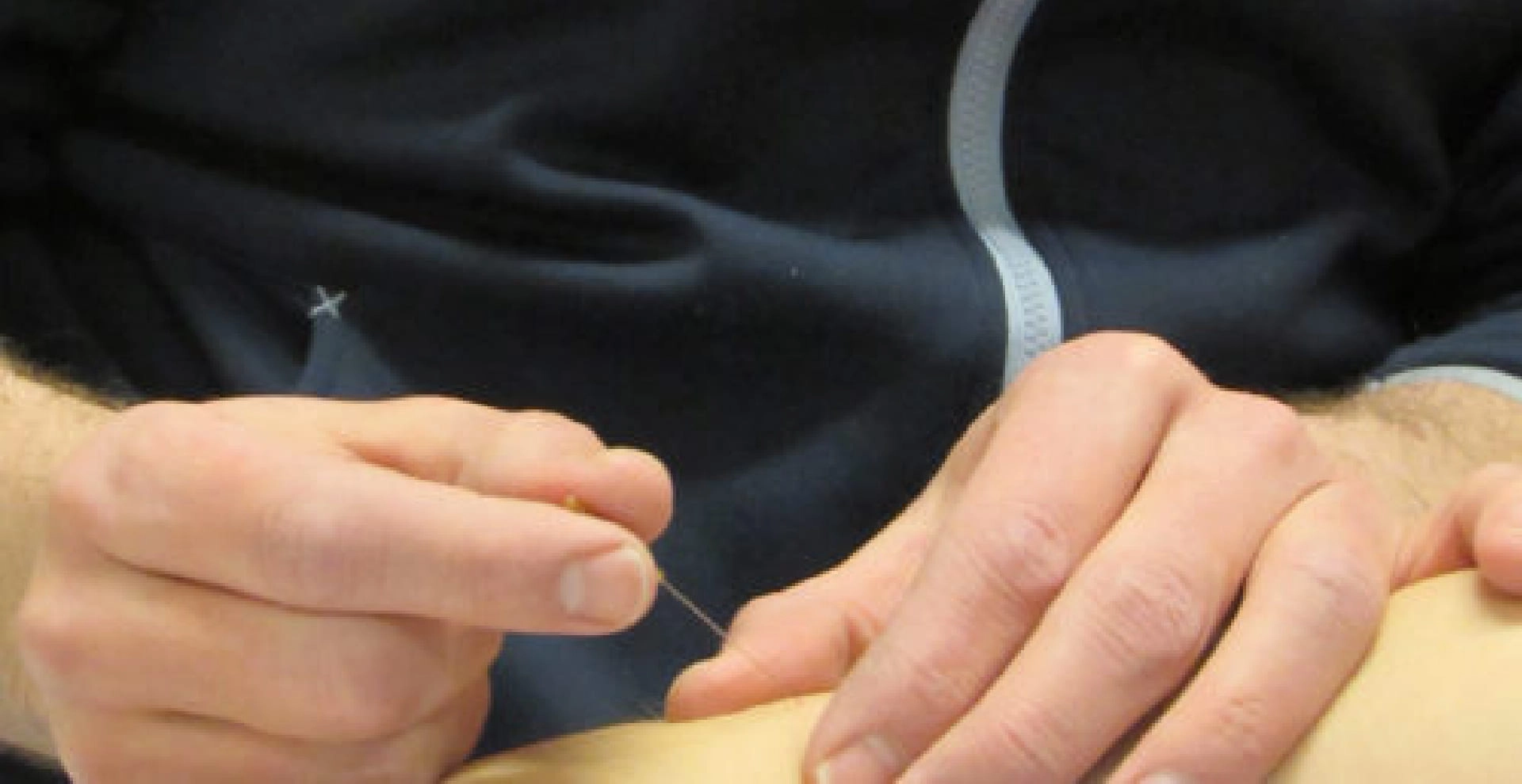 Dry needling kan helpen bij het behandelen van armpijn